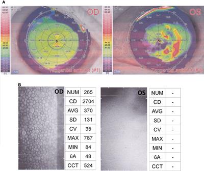 Case report: A case of ocular infection caused by Corynespora cassiicola